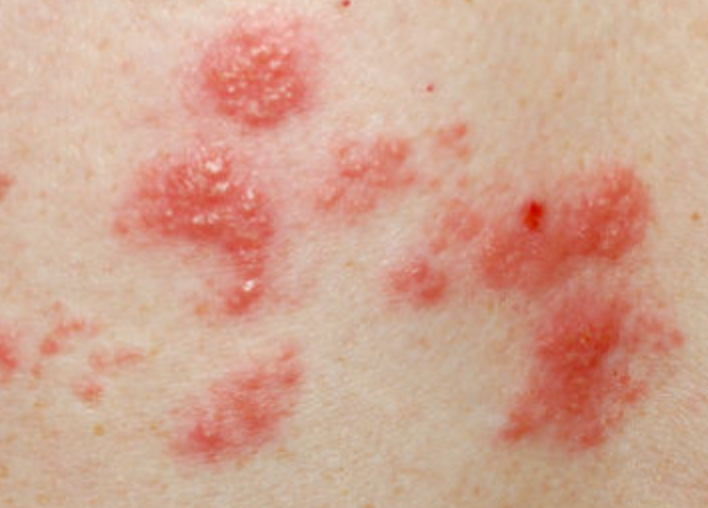 Besprechen von Warzen/Rosen/Gürtelrose